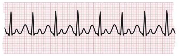 心电图显示心动过速